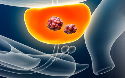 Graphic shows prostate cancer cells.