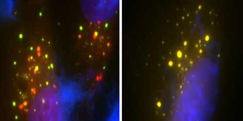 Cells on the left have the normal UBQLN2 gene and the red dots show the cell “garbage removal” process in action. The cells on the right have gene mutations that disrupt this process allowing toxic matter to build up in cells.